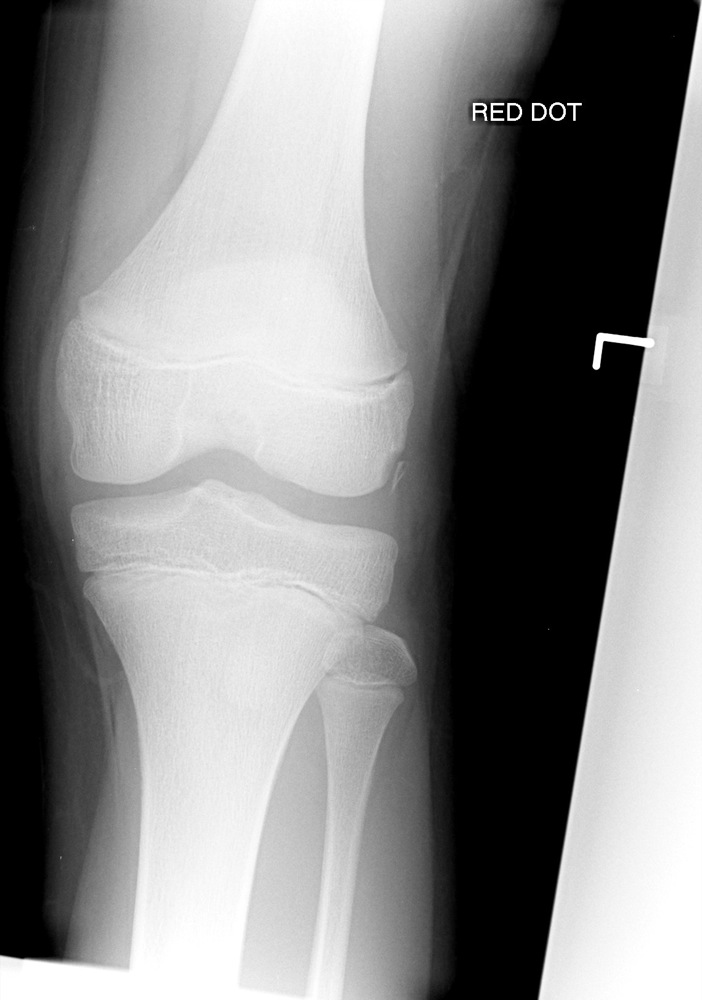 Lateral Femoral Condyle Avulsion Fracture